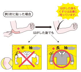 使用中及び使用後は、紫外線に当たらないようにしてください。1.戸外へ出るときは天候にかかわらず、濃い色の長袖やスラックス、サポーター等を着用し貼付部を紫外線に当てないでください。なお、白い生地や薄手の服では紫外線が透過するおそれがあります。2.海水浴や炎天下での作業、ゴルフ、テニス等屋外のスポーツをしないでください。3.はがした後も、少なくとも4週間は衣服、サポーター等により貼付部を紫外線に当てないでください。